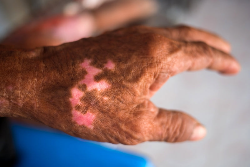 Hansen's Disease - Leprosy